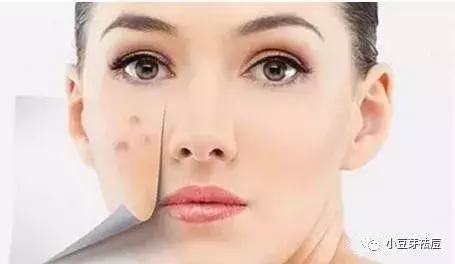 小豆芽老师,祛痘和去粉刺有什么区别呢?如何区