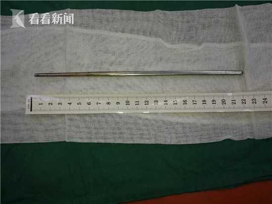 17个月大女童含着筷子玩耍摔倒 筷子从上颚插