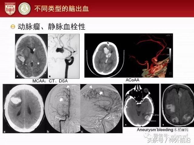 华山医院毛颖:自发性脑出血何时需要外科手术