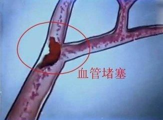 身体发出这3个信号暗示你血管堵塞了，六种食物经常吃下去，血管