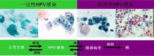 从HPV感染到宫颈癌要经历哪些过程?