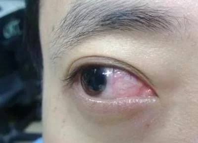 澳门永利官网:医生告诫:眼睛出现这3种异常变化,小心肝脏出现问题! 澳门永利官网:医生告诫:眼睛出现这3种异常变化,小心肝脏出现问题!