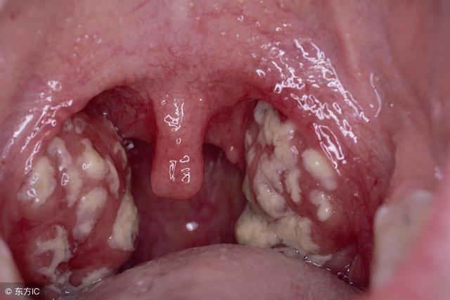 扁桃体发炎有什么危害？要学会这5个方法护理