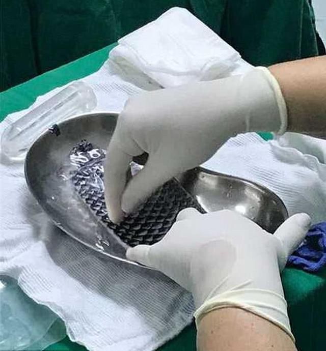 女子生来无生殖器,医生用鱼皮再造,与男友成功完成“亲密行为”