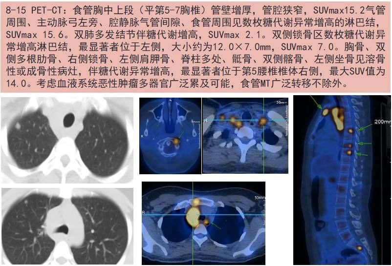 26岁女孩食道癌广泛转移?这个病例厉害了