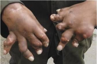 尿酸过高怎么办?推荐3个降尿酸食疗方,快速便