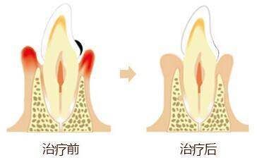 一招去口臭，不管什么引起的口臭，分分钟就能做到