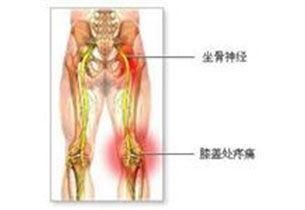 腰间盘突出压迫神经腿疼该怎么办?