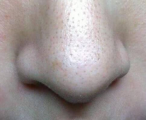 毛孔里的小颗粒怎么都挤不完,那是因为脸上螨