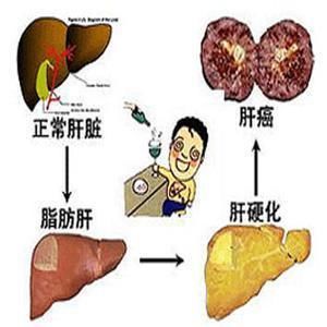 如何防止肝炎