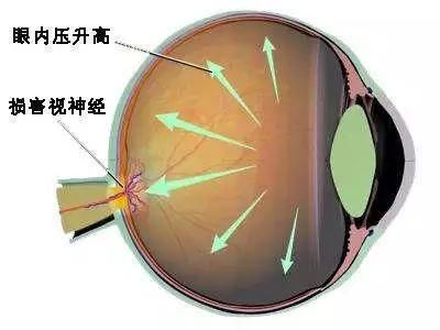 高度近视眼底图片 t011c637989670a44eb.jpg