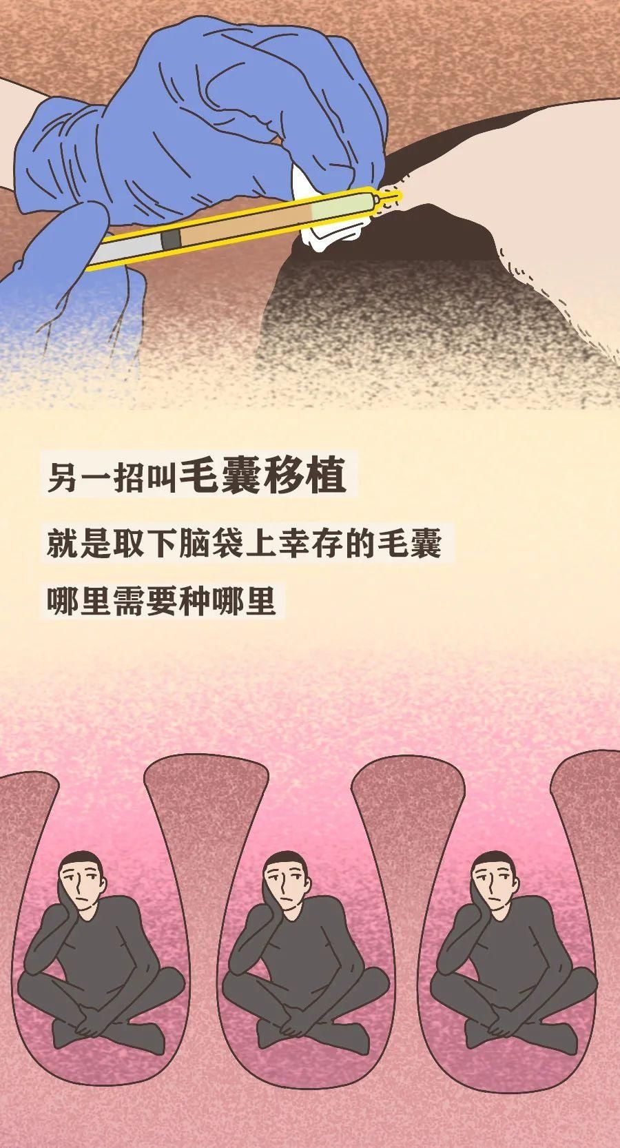 真男人，都容易秃