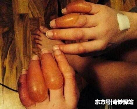 俄罗斯美女聚会后醉倒,在街上冻了一晚,醒后发现手指“变异”了