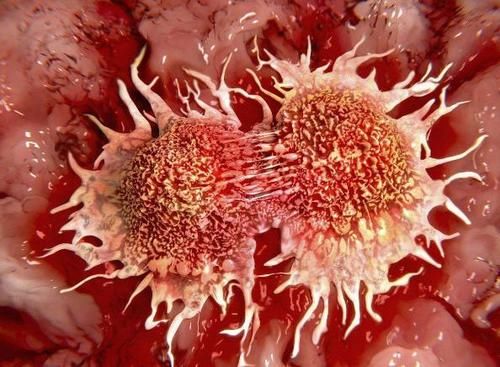 胃癌能活多久?手术治疗需要花多少钱?(内附胃