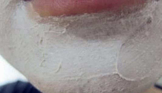 螨虫在脸上来回乱爬? 用家中一神奇膏, 3天