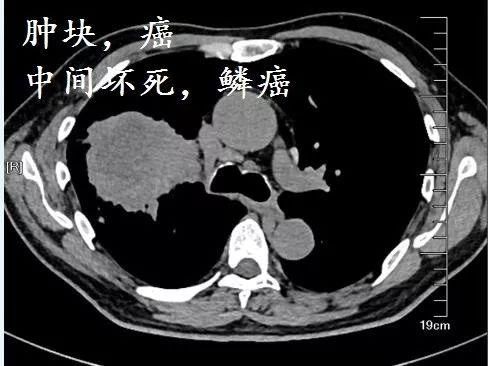 肺CT也会装酷:如何从CT上看出肺癌的病理类型?