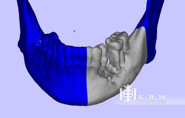 男子患癌险成“割脸人” 哈医大肿瘤医院3D打印为其重建新颜