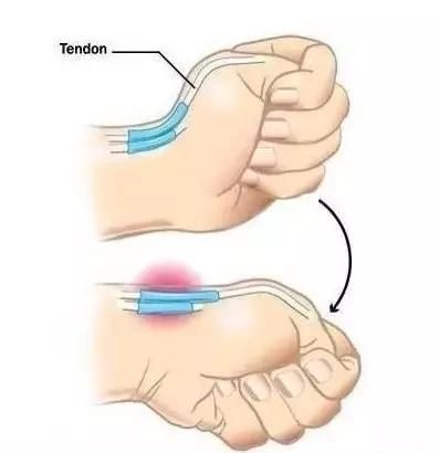手指疼难伸直,你可能得了腱鞘炎