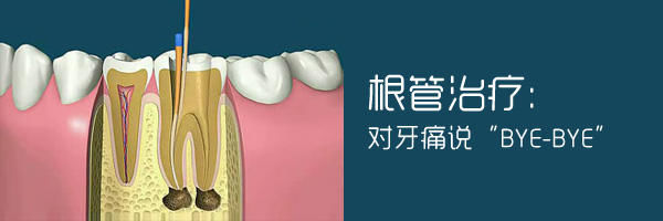 牙髓炎可以保守治疗吗?根管治疗有没有副作用