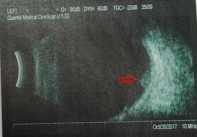 小凤雅的眼癌到底是什么？