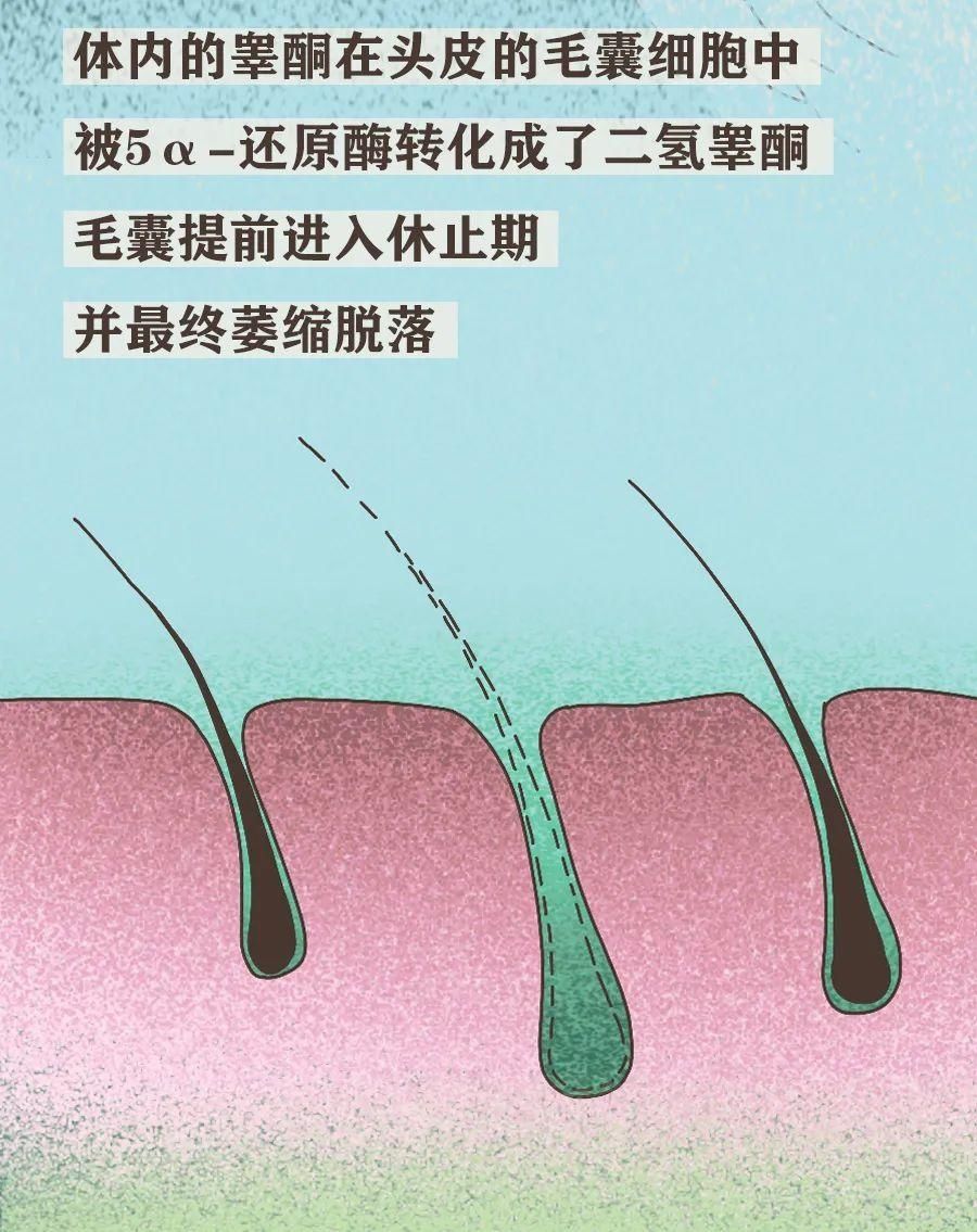 真男人，都容易秃