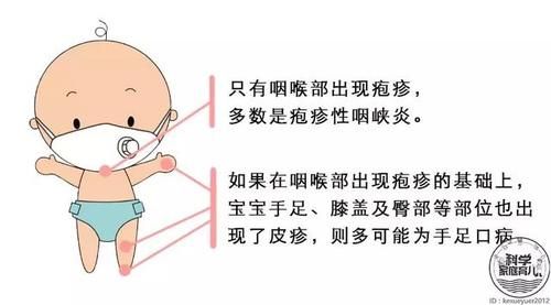 手足口"姊妹病"大爆发!家长牢记"8字方针"!_【快资讯】