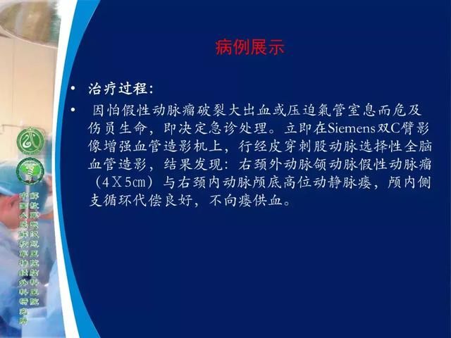 39年前开创“复合手术”，治愈颅底高位颈内动静脉瘘