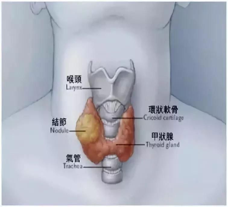 甲状腺为什么爱找女人麻烦?别担心，90%可治愈
