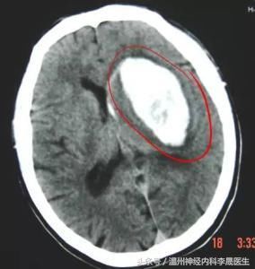 常见部位脑出血的影像学及临床表现