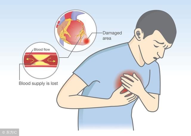 心源性休克是心肌梗塞导致的吗?诊断标准是什