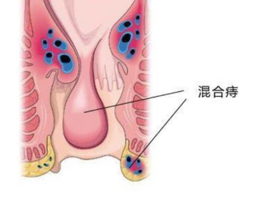 混合痔上门,这几种症状就会逐渐表现出来,别小