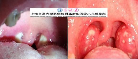 12岁男孩“感冒”1年，移植骨髓才能治愈