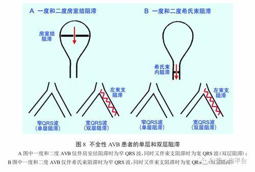 搭脉怎么判断早搏_早搏心电图怎么看图解(3)