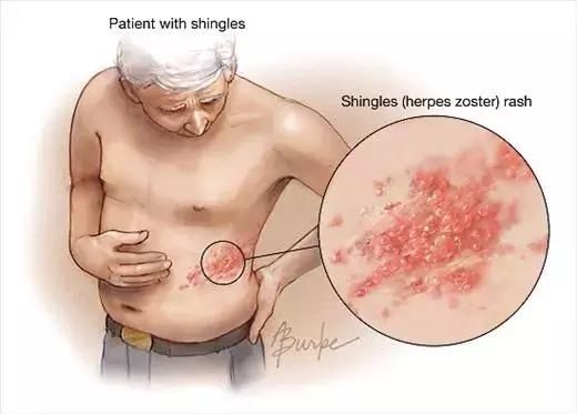 水痘痊愈就能终生免疫？其实病毒仍潜伏在神经