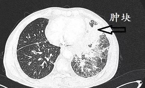 肺CT也会装酷:如何从CT上看出肺癌的病理类型?