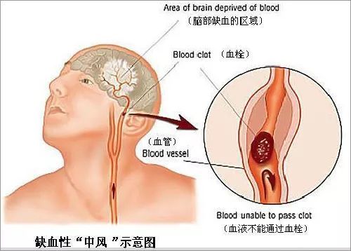 提醒：6个信号一出现，不是脑出血，就是脑血栓，莫忽视！