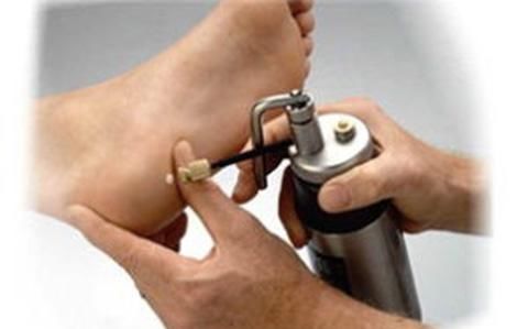 跖疣有什么特点 跖疣会给人带来哪些危害