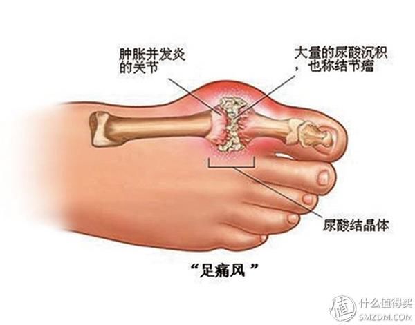 痛起来就晚了!高尿酸会短命,早起往温水里撒5