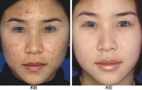 苗医生祛痘多少钱费用