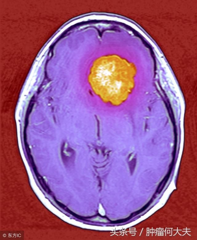 脑膜瘤有啥症状？怀疑脑膜瘤要做哪些检查？