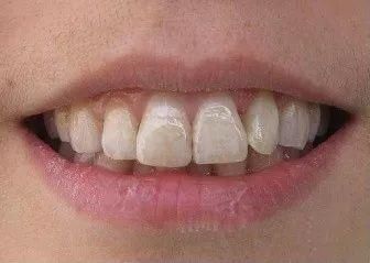 孩子用含氟牙膏会导致氟斑牙?牙膏说:这锅我可