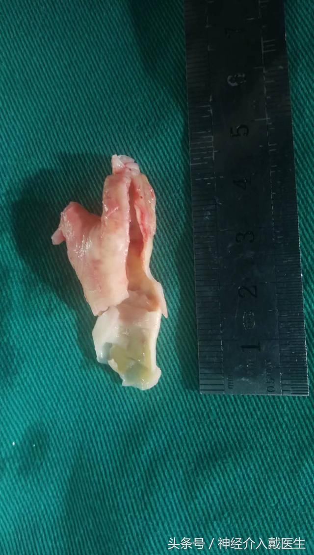 一种发现颈动脉病变最简单的办法