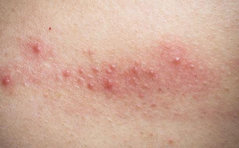 吃什么药能治湿疹 t015852d882a37a524d.jpg