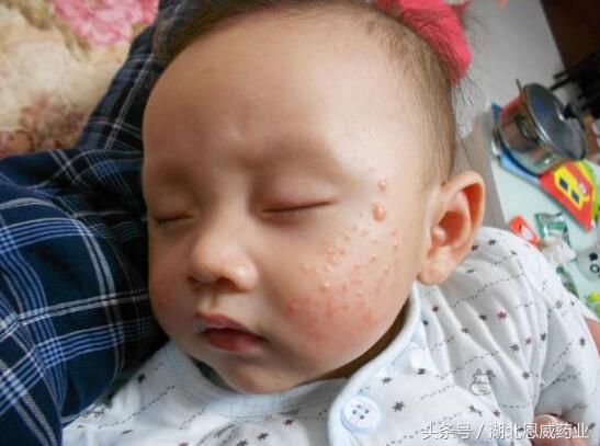 宝宝湿疹、皮炎、痤疮、皮脂腺增生的区别是什