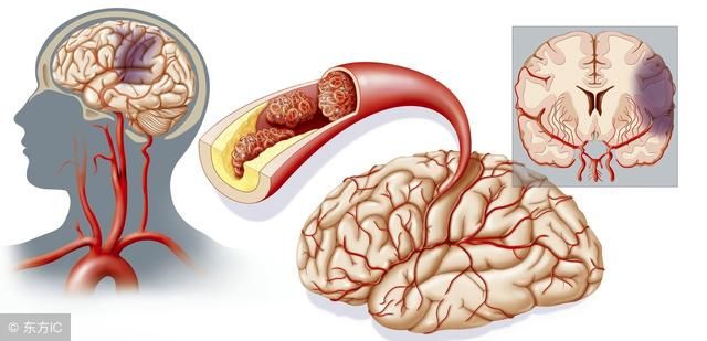 通常脑梗死发生在哪些人身上，具体的症状是什么