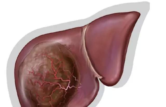 肝癌不痛不痒，四个身体症状提醒你:肝癌正在慢慢靠近，莫忽视!