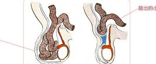5个月宝宝疝气导致肠坏死,婴儿疝气应该引起大