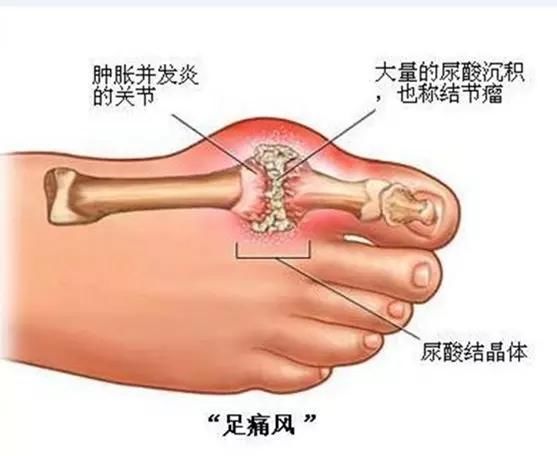 痛风怎么吃？痛风患者的饮食清单请收好