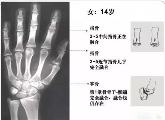 干货 计算孩子的骨龄,以及得知孩子的最终身高