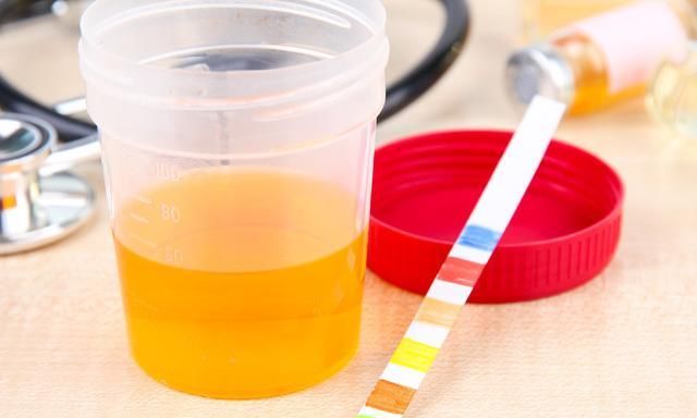 尿液中酮体高是怎么回事呢?